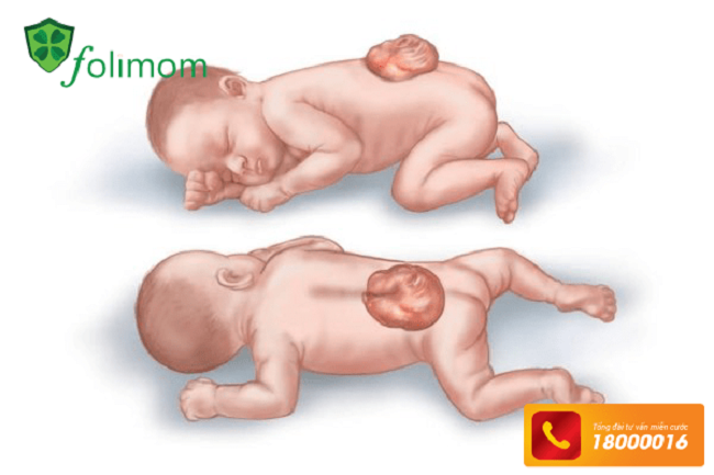Trẻ sinh ra có nguy cơ bị dị tật ống thần kinh nếu mẹ bị đột biến gen MTHFR