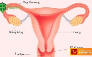 Đa nang buồng trứng 2 bên gây vô sinh ở phụ nữ